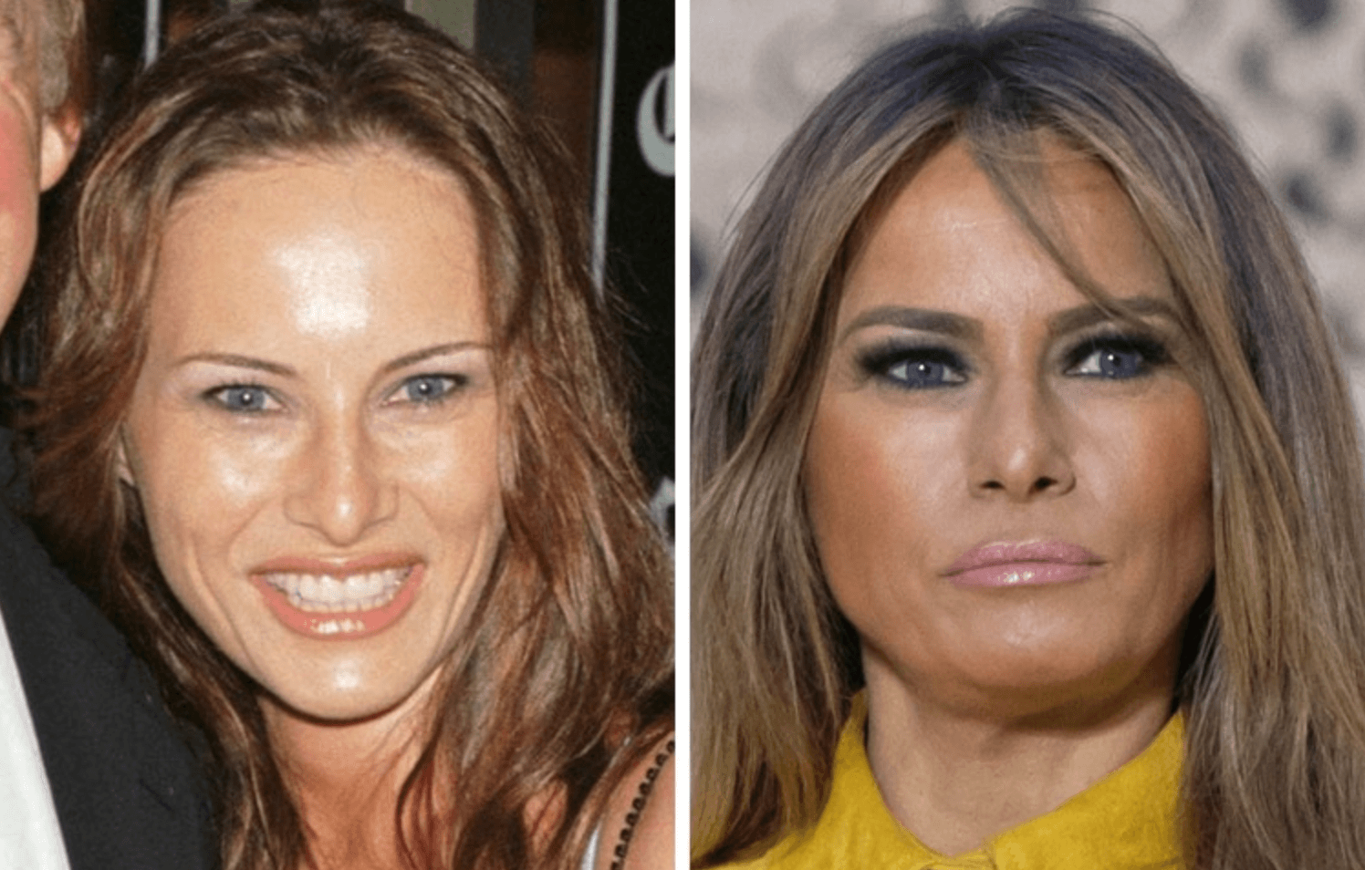 Melania Trump Says She's Had Zero Plastic Surgery and Is Against Botox, 'I Will Age Gracefully!'